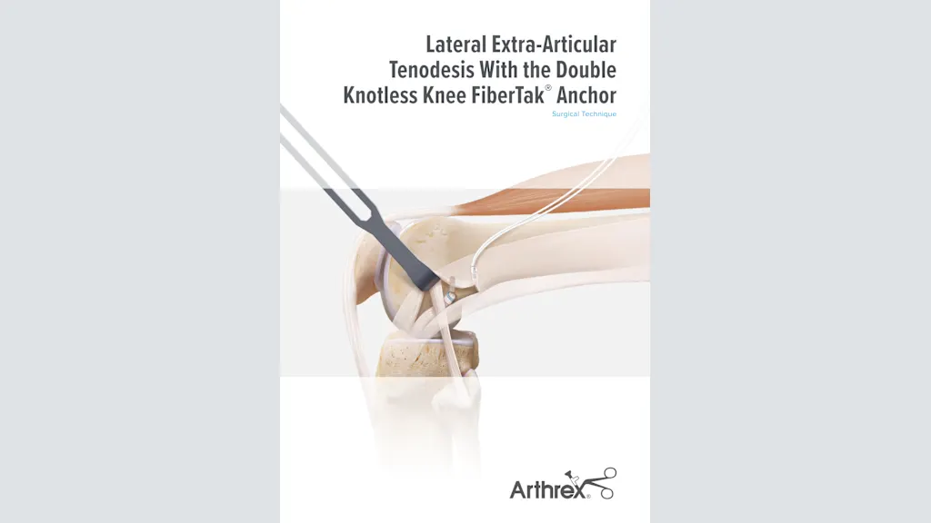 Lateral Extra-Articular Tenodesis With the Double Knotless Knee FiberTak®  Anchor