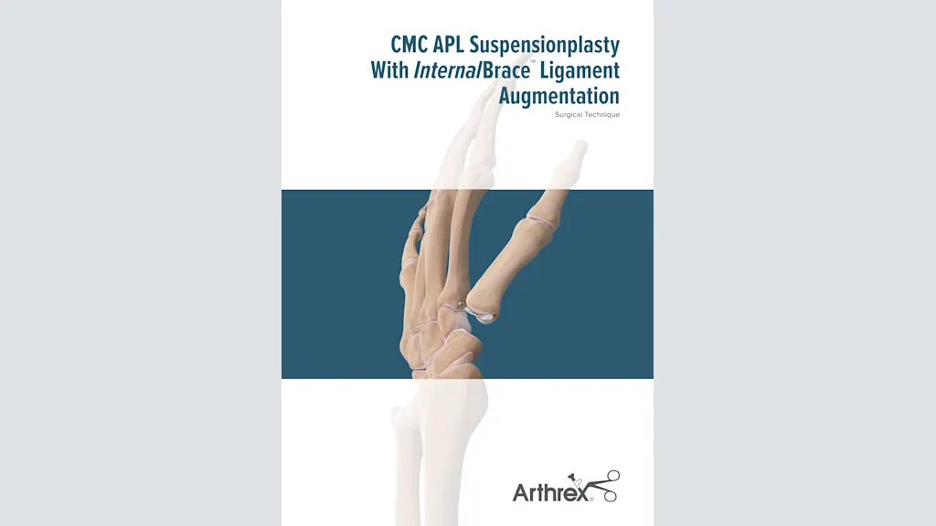CMC APL Suspensionplasty With InternalBrace™ Ligament Augmentation
