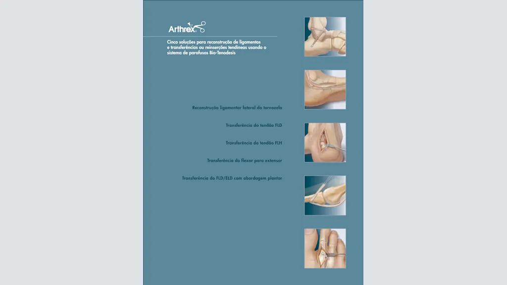 Cinco soluções para reconstrução de ligamentos e transferências ou reinserções tendíneas usando o sistema de parafusos Bio-Tenodesis