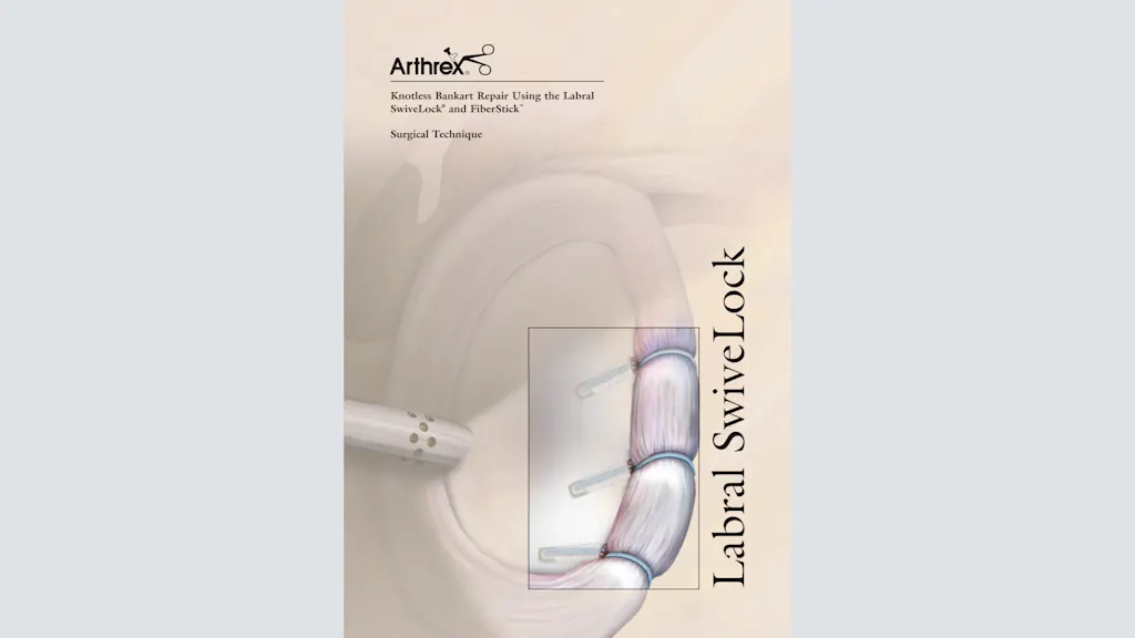 Knotless Bankart Repair Using the Labral SwiveLock® and FiberStick™