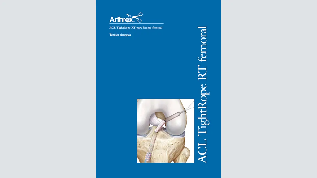 ACL TightRope RT para Fixação Femoral