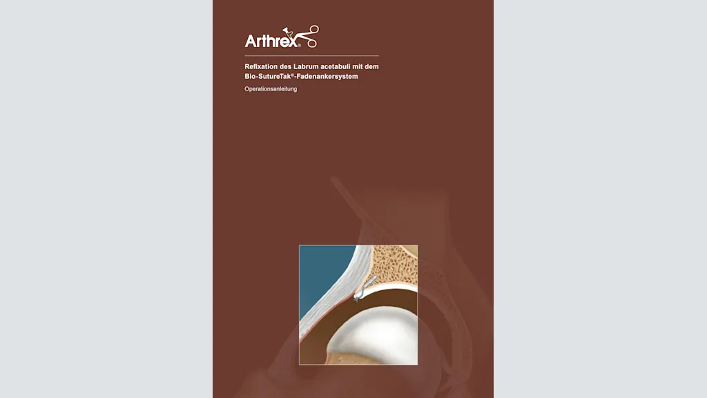 Refixation des Labrum acetabuli mit dem Bio-SutureTak®-Fadenankersystem