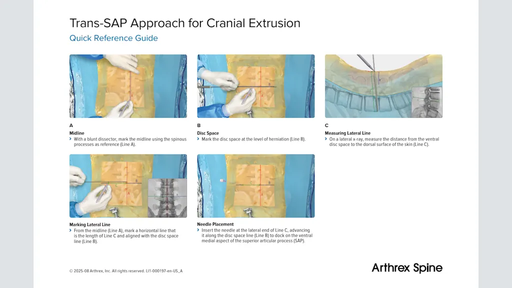 Trans-SAP Approach for Cranial Extrusion - Quick Reference Guide