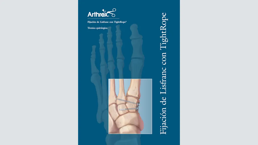 Fijación de Lisfranc con TightRope®