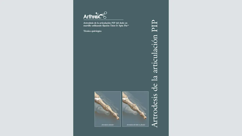 Artrodesis de la articulación PIP del dedo en martillo utilizando fijación Trim-It Spin Pin™