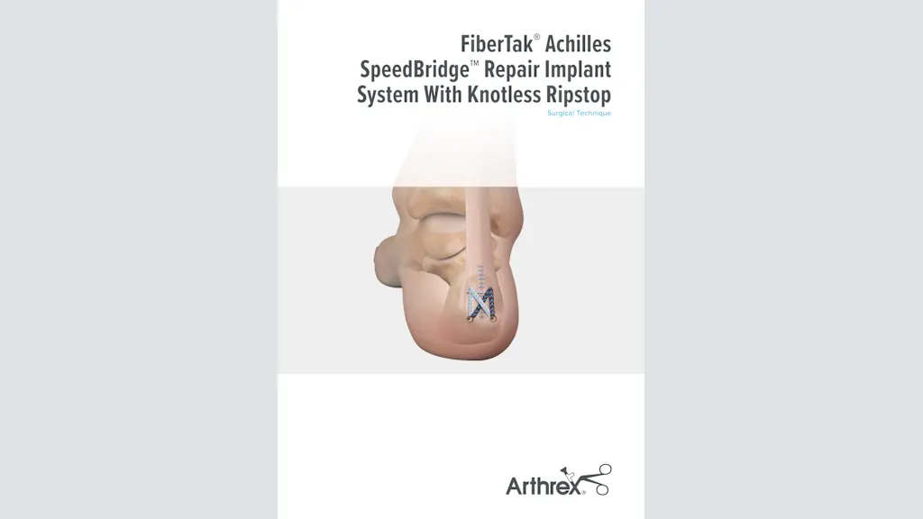 FiberTak® Achilles SpeedBridge™ Repair Implant System With Knotless Ripstop