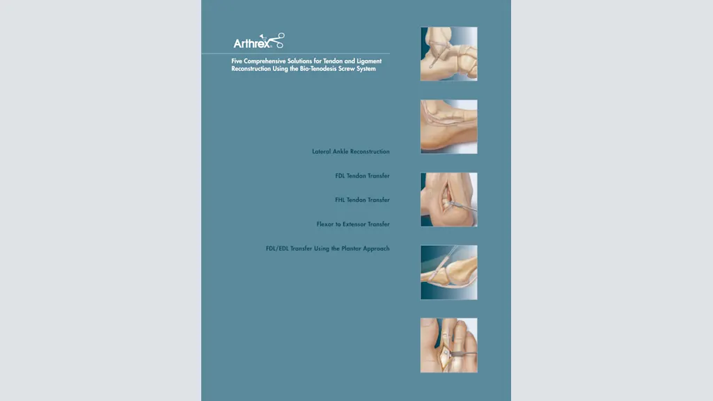 Five Comprehensive Solutions for Tendon and Ligament Reconstruction Using the Bio-Tenodesis™ Screw System