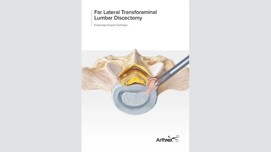 Arthrex - Far Lateral Transforaminal Endoscopic Lumbar Discectomy
