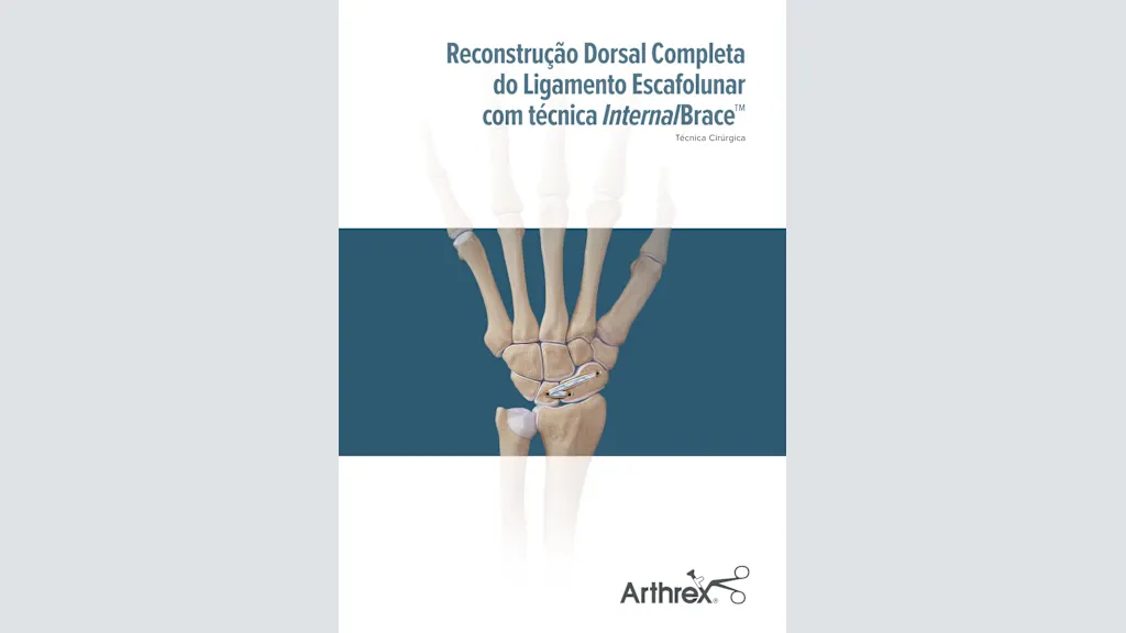 Reconstrução Dorsal Completa do Ligamento Escafolunar com Técnica InternalBrace™