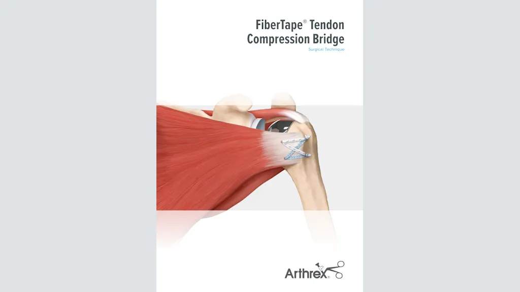 FiberTape® Tendon Compression Bridge
