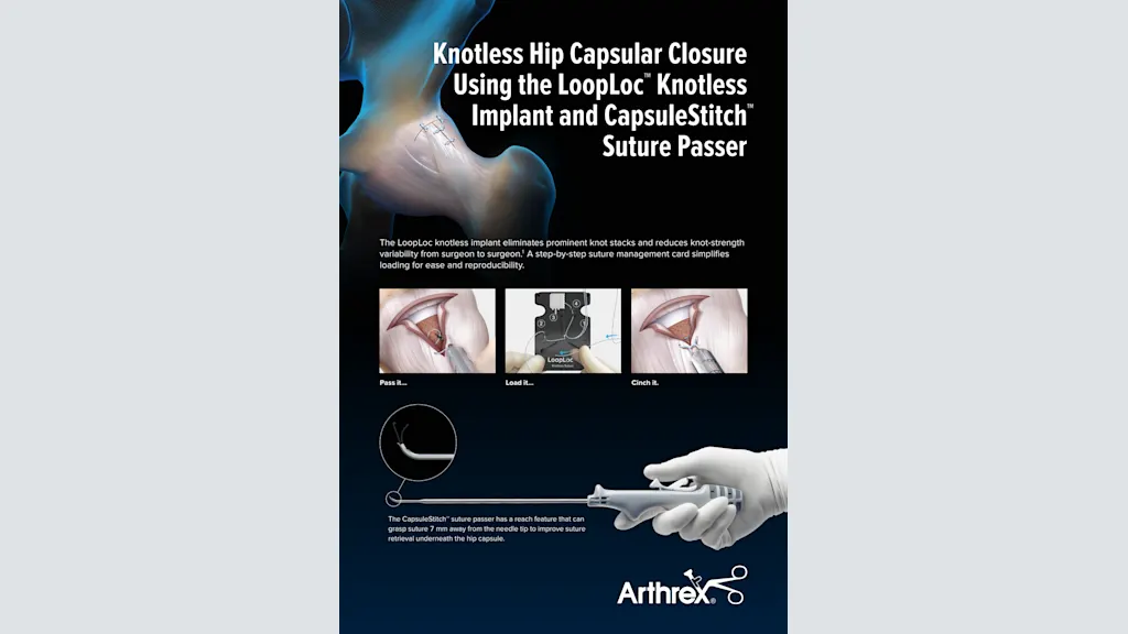Knotless Hip Capsular Closure Using the LoopLoc™ Knotless Implant and CapsuleStitch™ Suture Passer