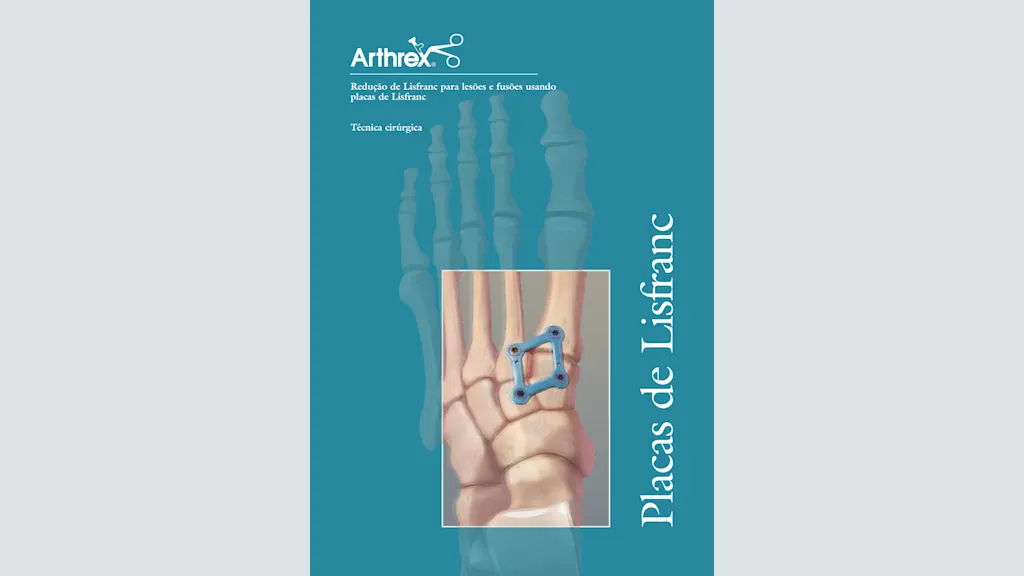 Redução de Lisfranc para lesões e fusões usando placas de Lisfranc