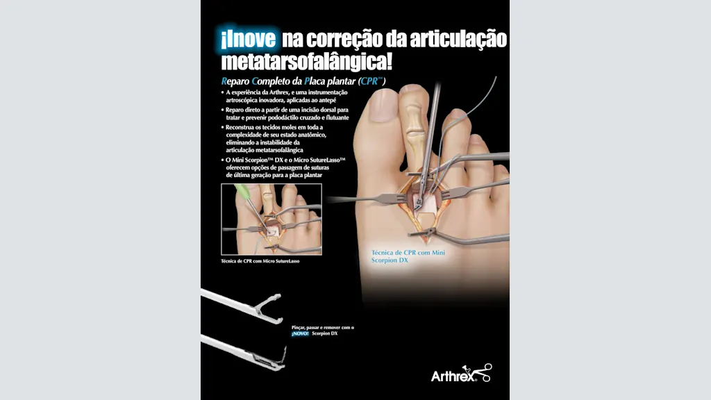 ¡Inove na correção da articulação metatarsofalângica! - Reparo Completo da Placa Plantar (CPR™)