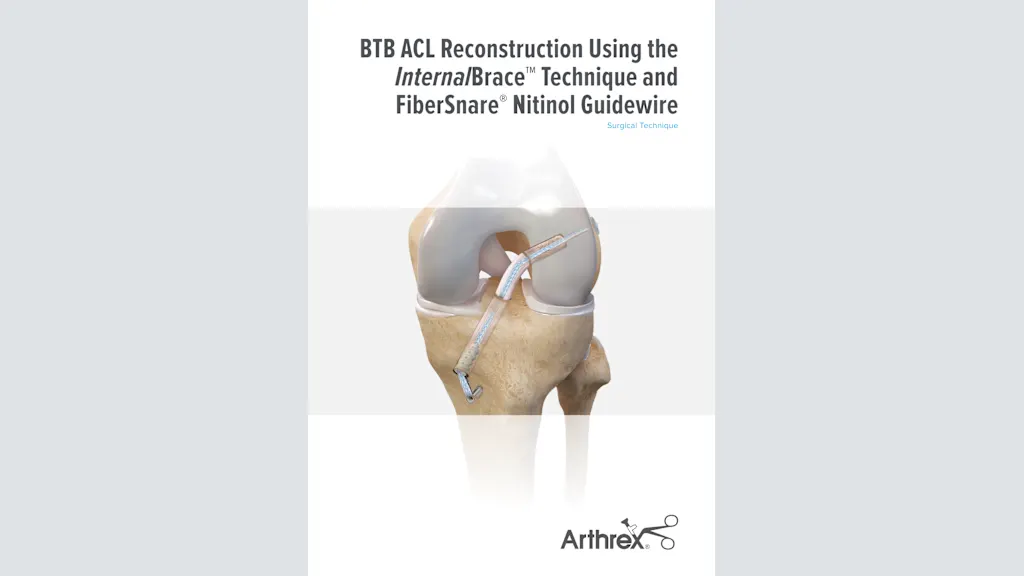 BTB ACL Reconstruction Using the InternalBrace™ Technique and FiberSnare® Nitinol Guidewire