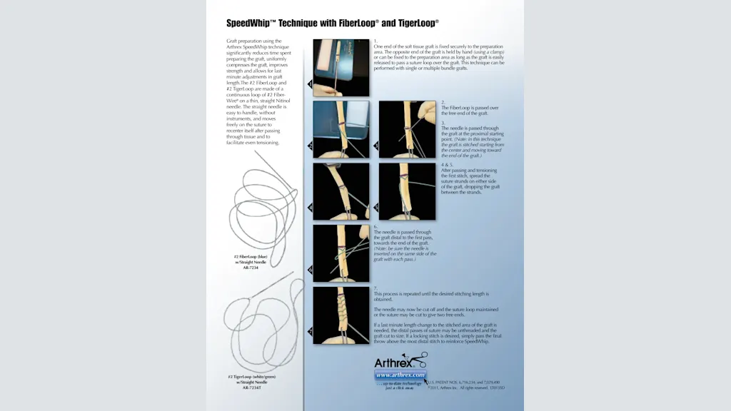 SpeedWhip™ Technique with FiberLoop® and TigerLoop®