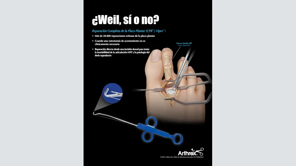 ¿Weil, sí o no? - Reparación completa de la placa plantar (CPR™) Viper™