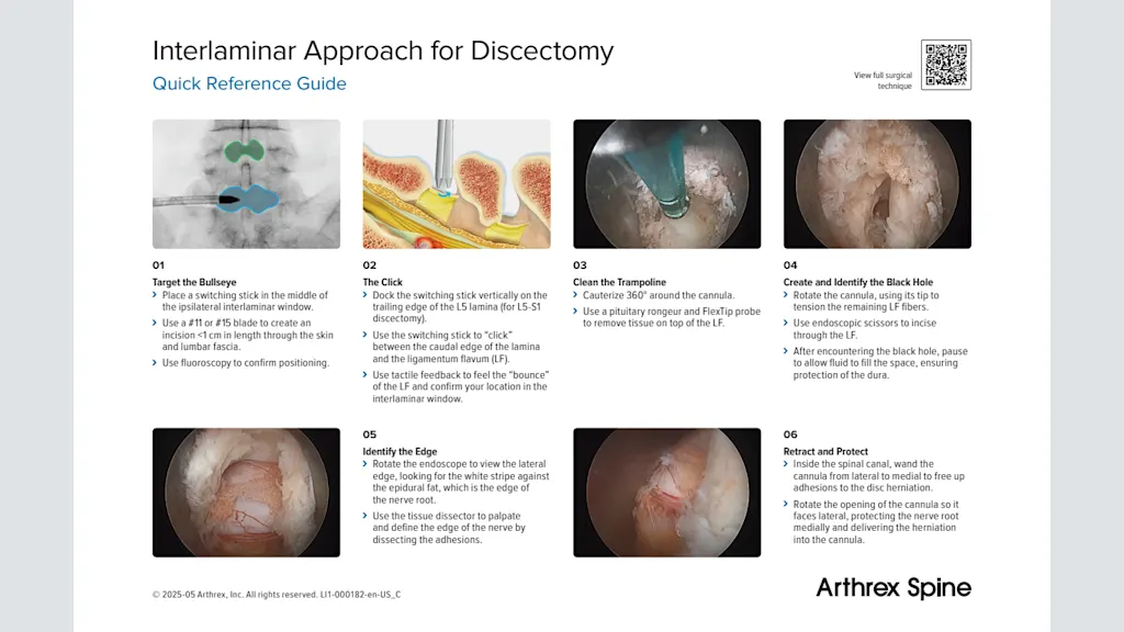 Interlaminar Approach for Discectomy