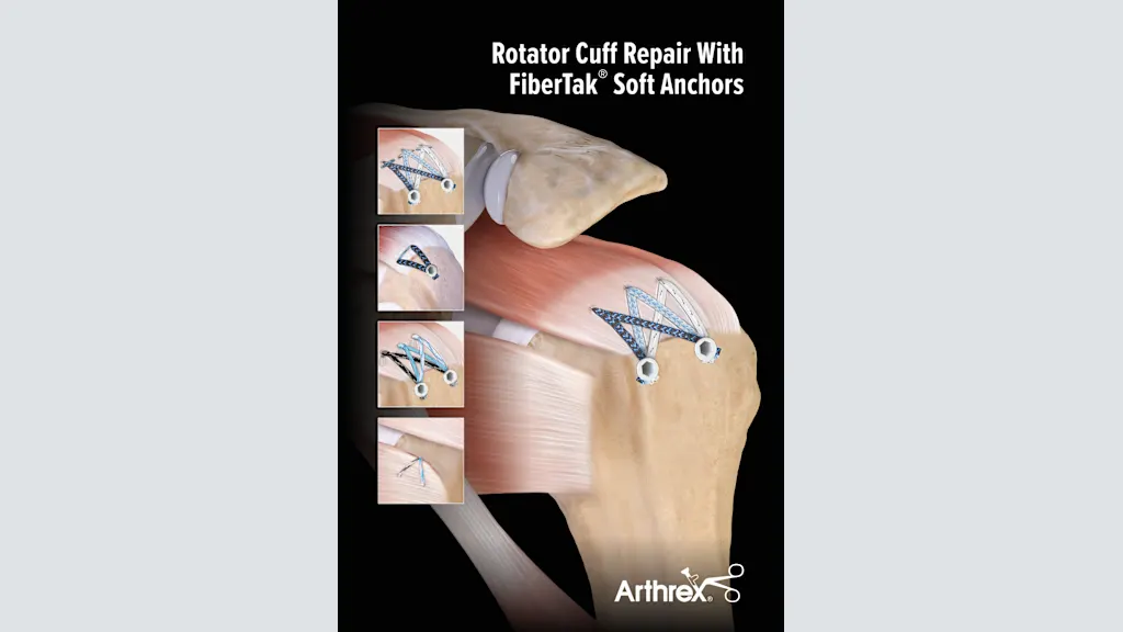 Rotator Cuff Repair with FiberTak® Soft Anchors
