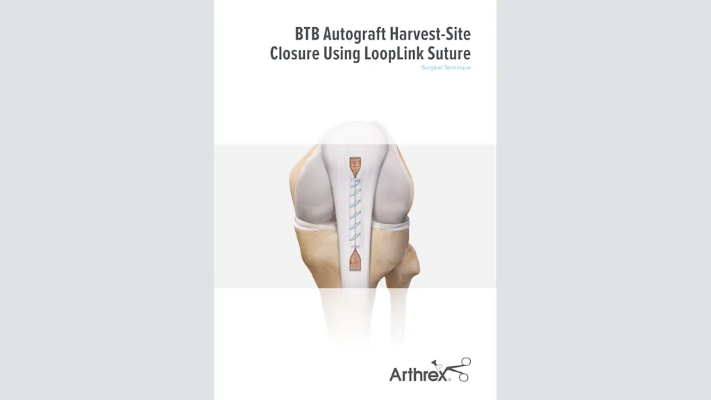 BTB Autograft Harvest-Site Closure Using LoopLink Suture