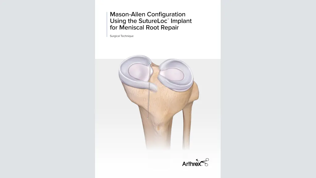 Mason-Allen Configuration Using the SutureLoc™ Implant for Meniscal Root Repair