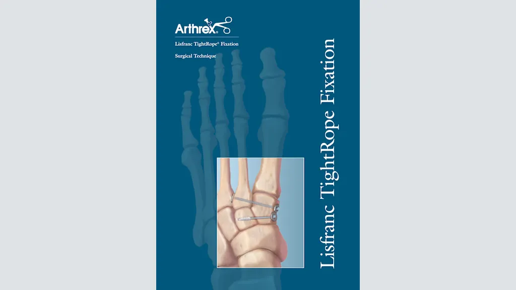 Lisfranc TightRope® Fixation Surgical Technique