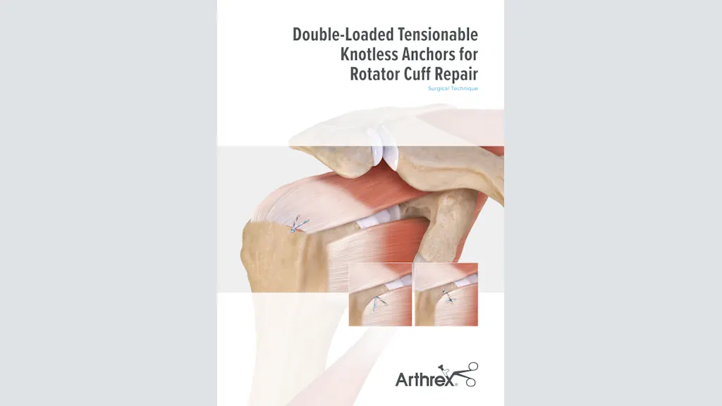 Double-Loaded Tensionable Knotless Anchors for Rotator Cuff Repair