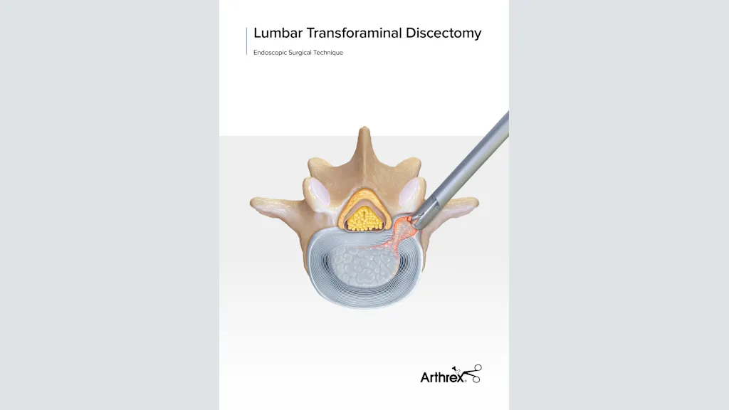 Arthrex - Transforaminal Endoscopic Lumbar Discectomy