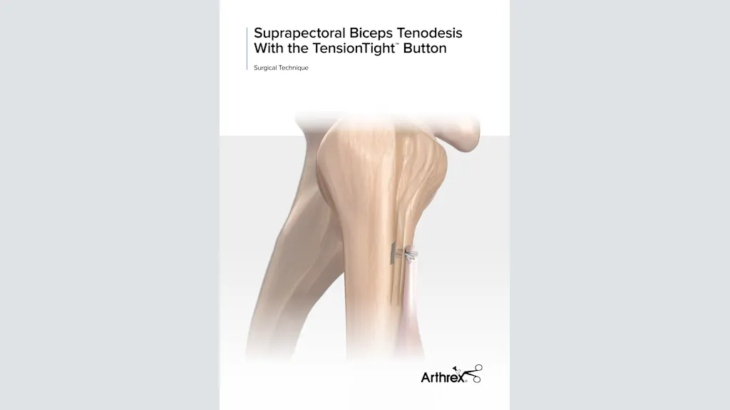 Suprapectoral Biceps Tenodesis With the TensionTight™ Locking Button