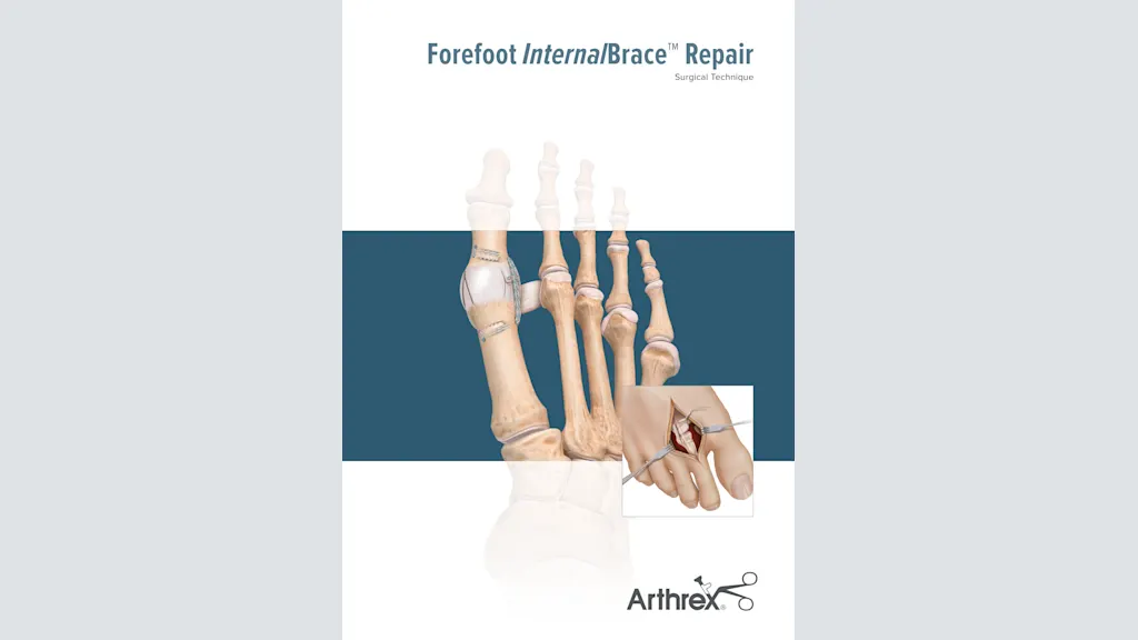 Forefoot InternalBrace™ Repair