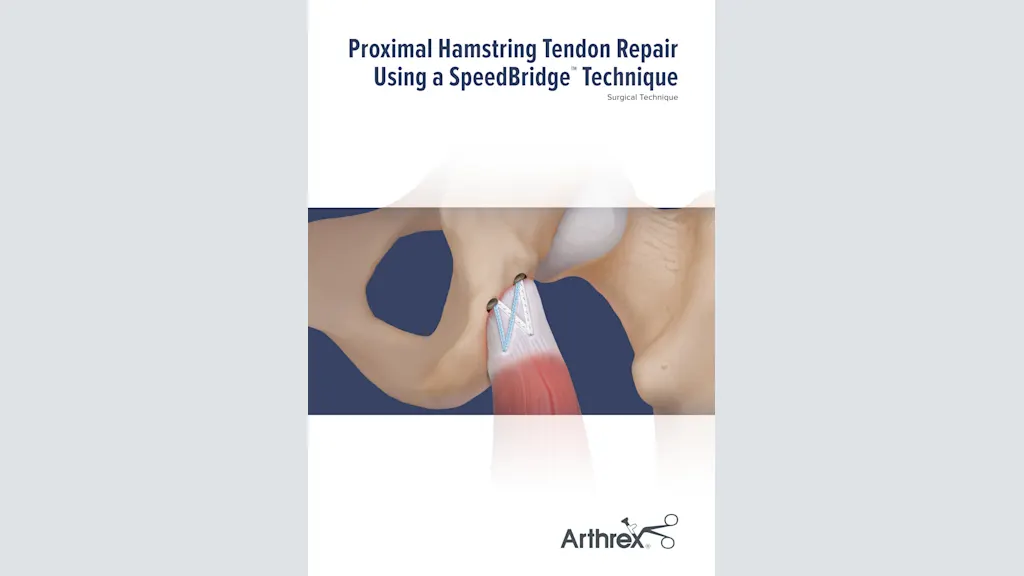 Proximal Hamstring Tendon Repair Using a SpeedBridge™ Technique