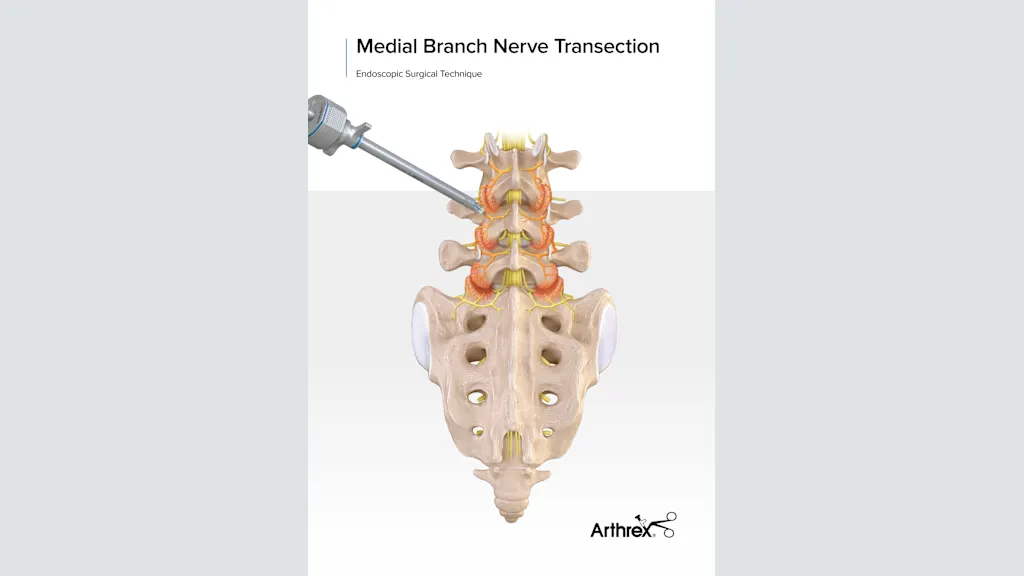 Arthrex - Medial Branch Transection