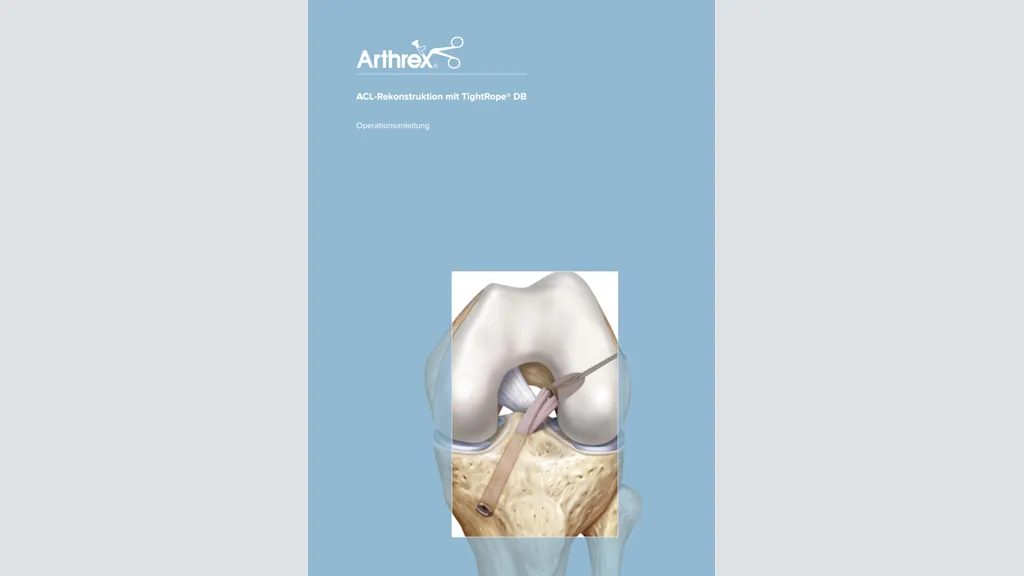 ACL-Rekonstruktion mit TightRope® DB