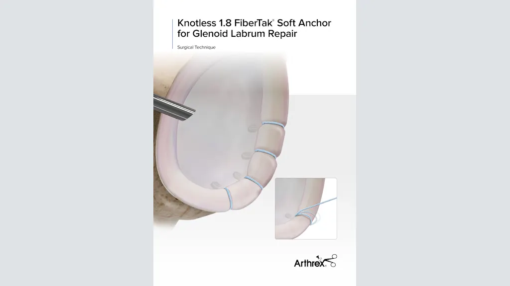 Knotless 1.8 FiberTak® Soft Anchor for Glenoid Labrum Repair
