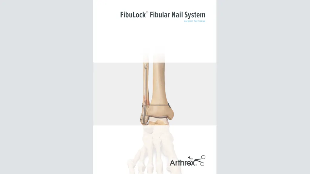 FibuLock® Fibular Nail System