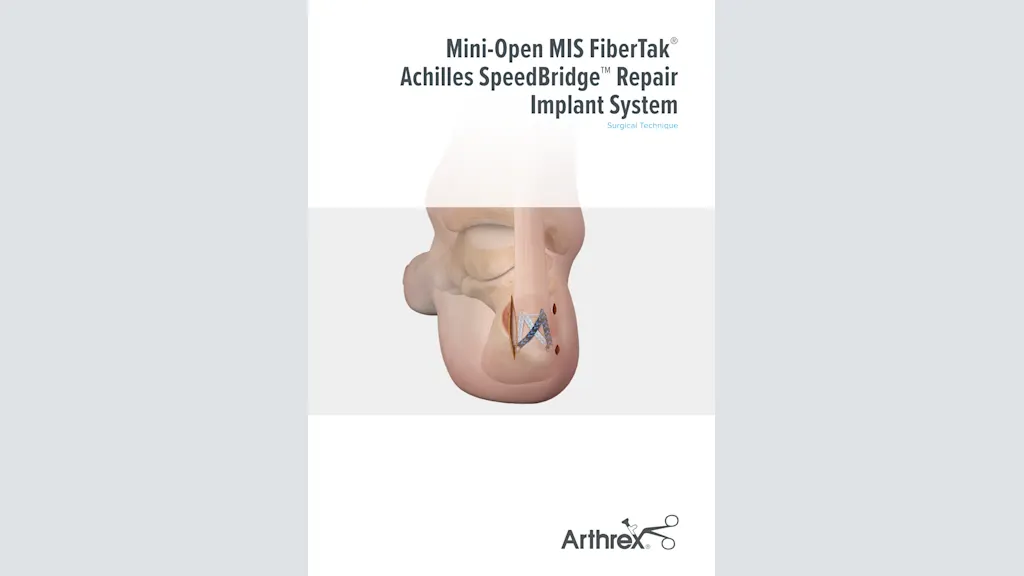 Mini-Open MIS FiberTak® Achilles SpeedBridge™ Repair Implant System
