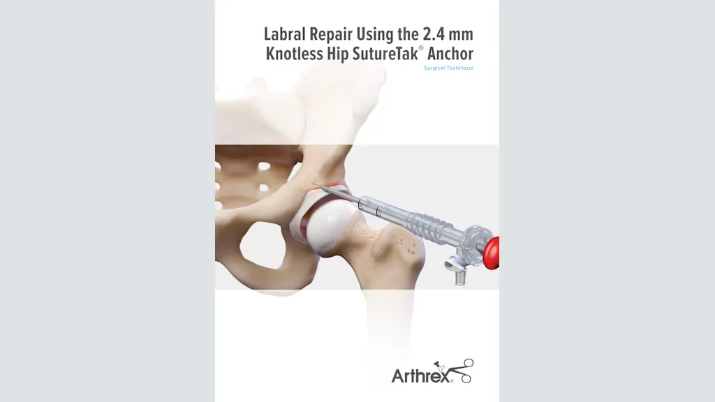 Labral Repair Using the 2.4 mm Knotless Hip SutureTak®  Anchor