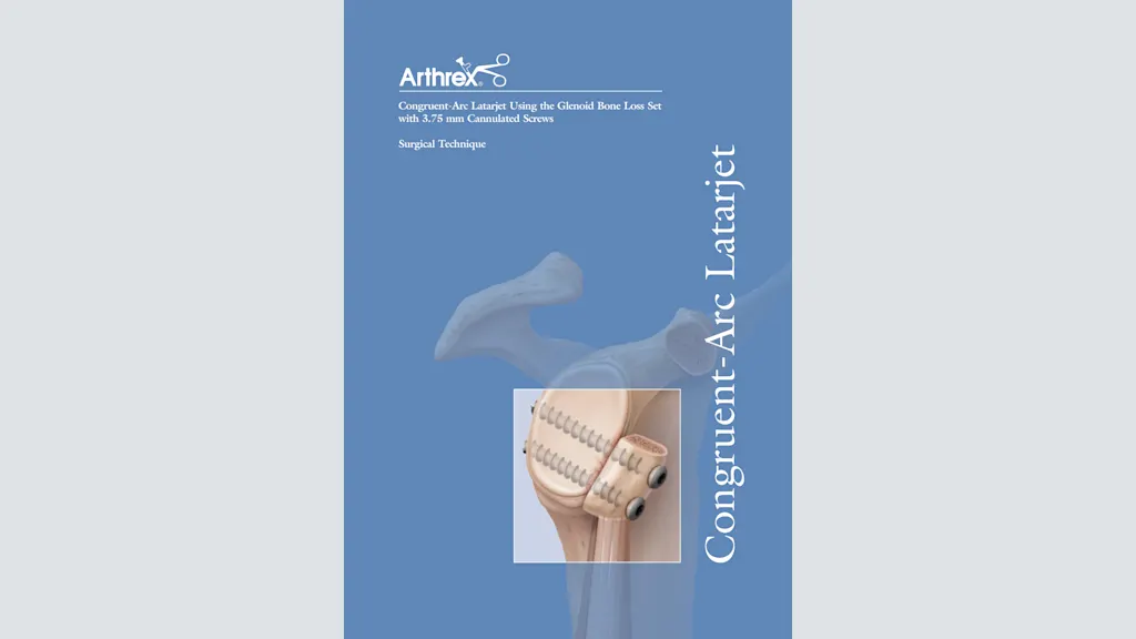 Congruent-Arc Latarjet Using the Glenoid Bone Loss Set with 3.75 mm Cannulated Screws