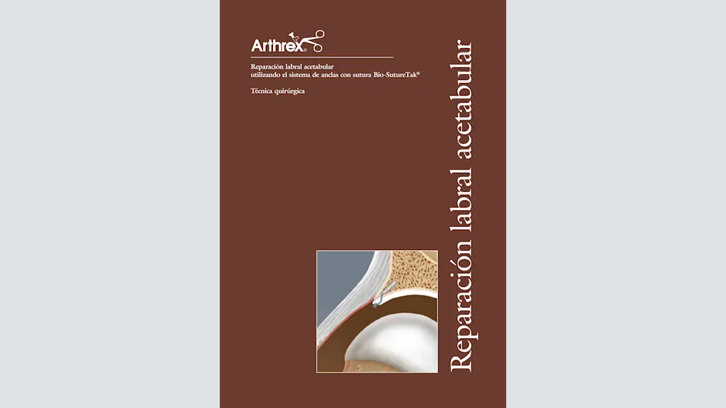 Reparación labral acetabular utilizando el sistema de anclas con sutura Bio-SutureTak®