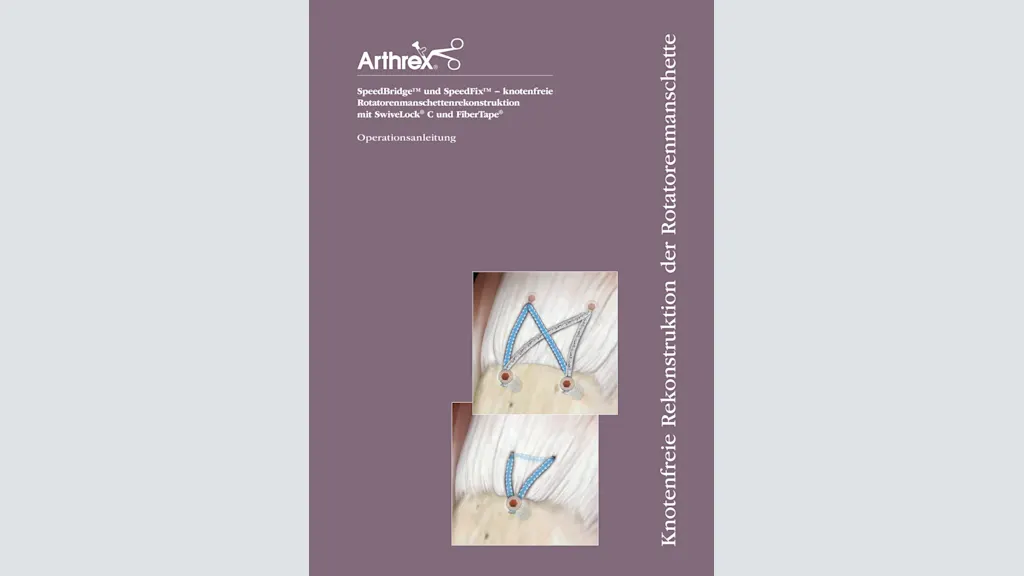 SpeedBridge™ und SpeedFix™ − knotenfreie Rotatorenmanschettenrekonstruktion mit SwiveLock® C und FiberTape®