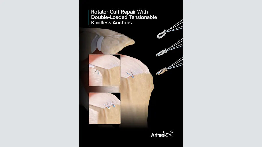 Rotator Cuff Repair With Double-Loaded Tensionable Knotless Anchors