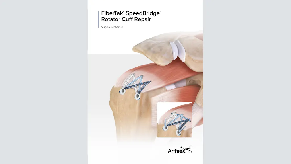 FiberTak® SpeedBridge™ Rotator Cuff Repair