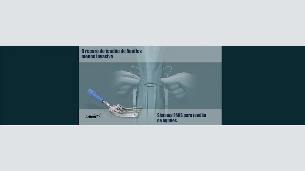 Sistema PARS para tendão de Achilles: O reparo menos invasivo