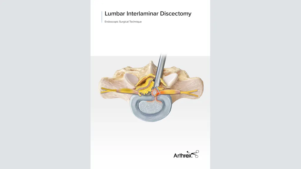 Lumbar Interlaminar Discectomy