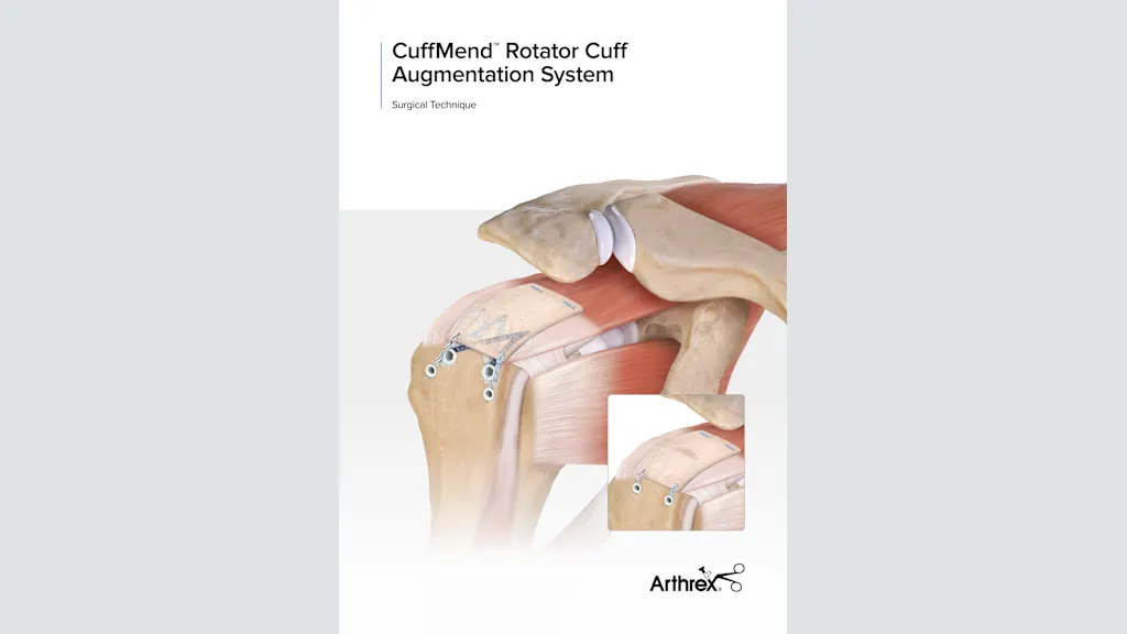 Arthrex - CuffMend™ Rotator Cuff Augmentation Technique