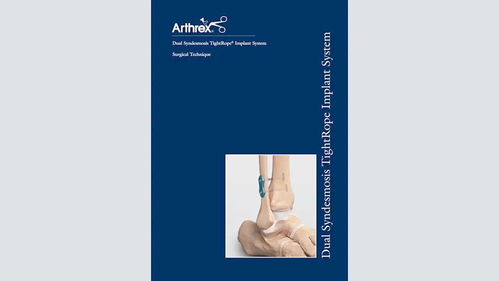 Dual Syndesmosis TightRope® Implant System