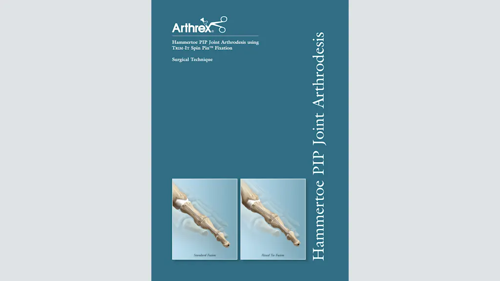 Hammertoe PIP Joint Arthrodesis using Trim-It Spin Pin™ Fixation