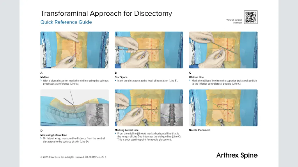 Transforaminal Approach for Discectomy Quick Reference Guide