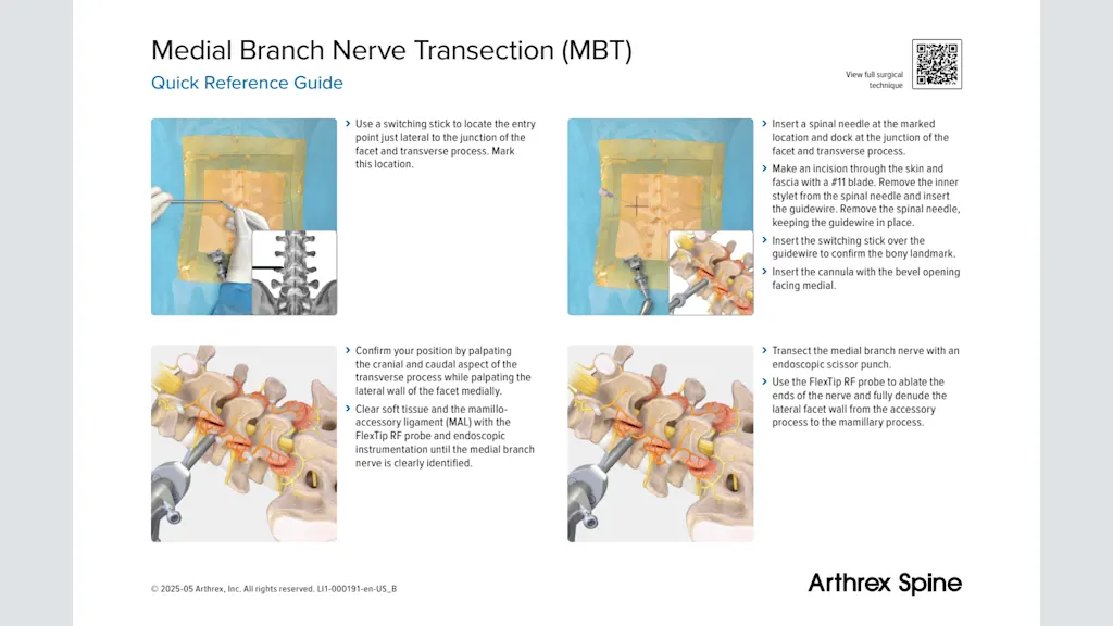 Medial Branch Nerve Transection (MBT)