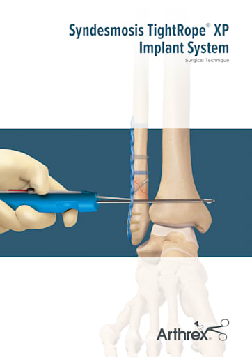 Arthrex - Syndesmosis TightRope® Implant System