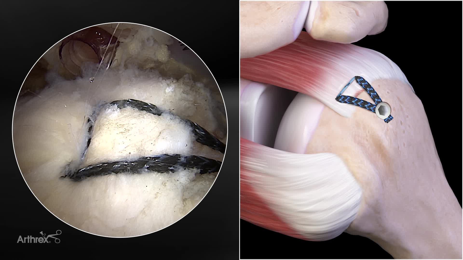Arthrex - #2 FiberWire Suture, 38 in (Blue) w/two Tapered